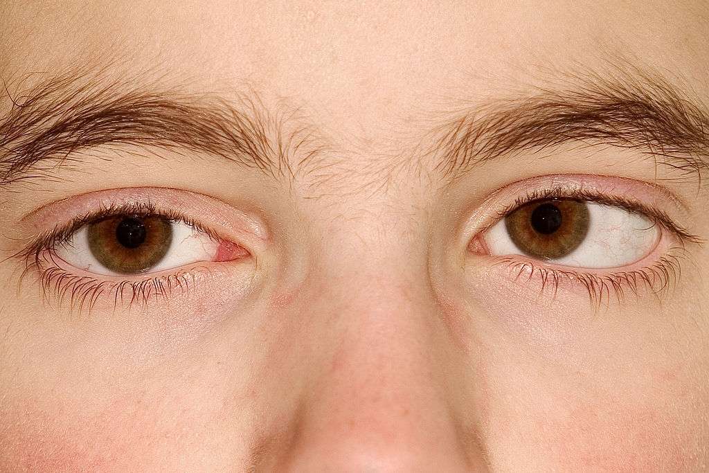 Estrabismo pode voltar mesmo depois da cirurgia, aponta estudo – Um ...