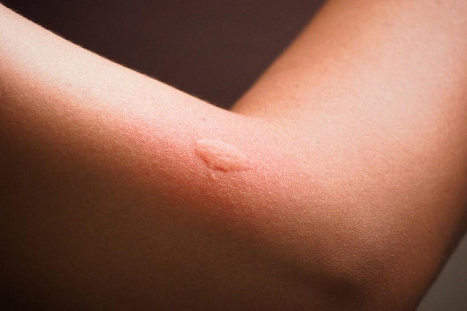 Why Do Mosquitoes Leave Itchy Bumps